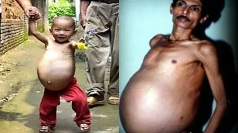 Illustration or depiction of Sanju Bhagat’s abdominal swelling before surgery